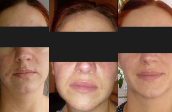 DemoDerm Rosacea Basic Care - Buy now!
