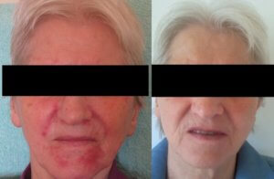 DemoDerm Rosacea Basis Pflege - Jetzt kaufen!